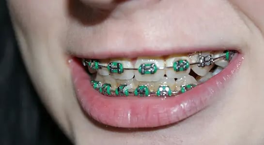 A jaw-dropper: Some orthodontists think we use braces too much