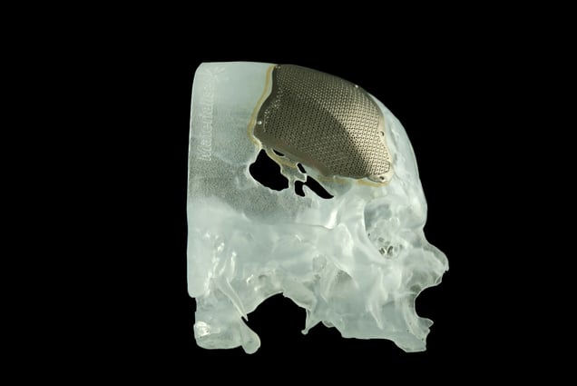 3D printed skull plate