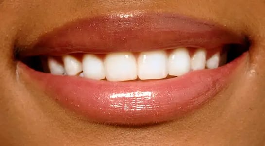 Smile: Orthodontic startup Candid raises $63.4m 